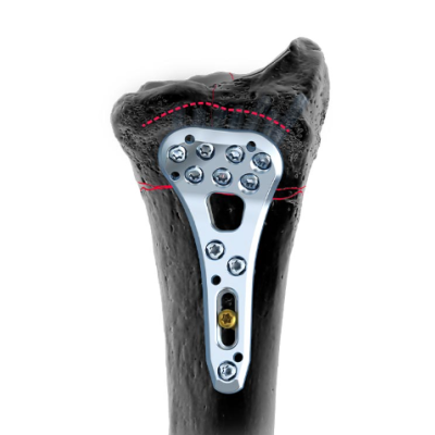 Aptus 2.5 Trilock Dist.Rad.Framepl  Right Volar [Pack of 1]