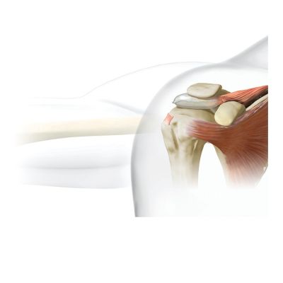 Stryker Inspace Implant - Medium [Pack of 1]