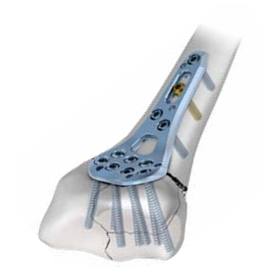 Aptus Infix Locking Plate 2.5 Trilock Dist.Rad.Framepl Volar Right [Pack of 1]