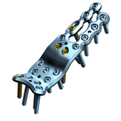 Aptus 2.5 Trilock Wrist Fusion Pl Short Bend [Pack of 1]