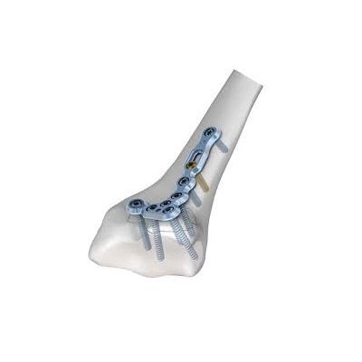 Medartis 2.5 Trilock Dist.Rad.Corr.Pl Volar Right, A-4750.26 [Pack of 1]