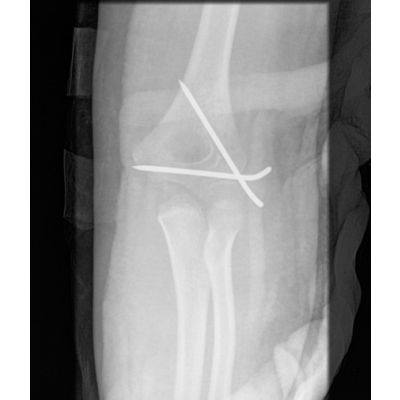 Timberline K Wire Chamfered Lateral [Pack of 1]