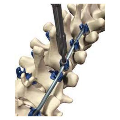 Polyaxial 4.5X10MM Occip Scr Virage Blue [Pack of 1]