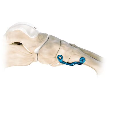 LAVENDER  Lapidus Plate Plantar Lapidus Arthrodesis Plate - Size 3 - 7 MM - Sterile [Pack of 1]