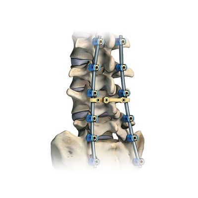 Polyaxial 5.5TI 6.5X40 Ma Red Scr St [Pack of 1]